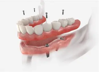 Crown & Fixed Dentures