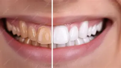Teeth Whitening